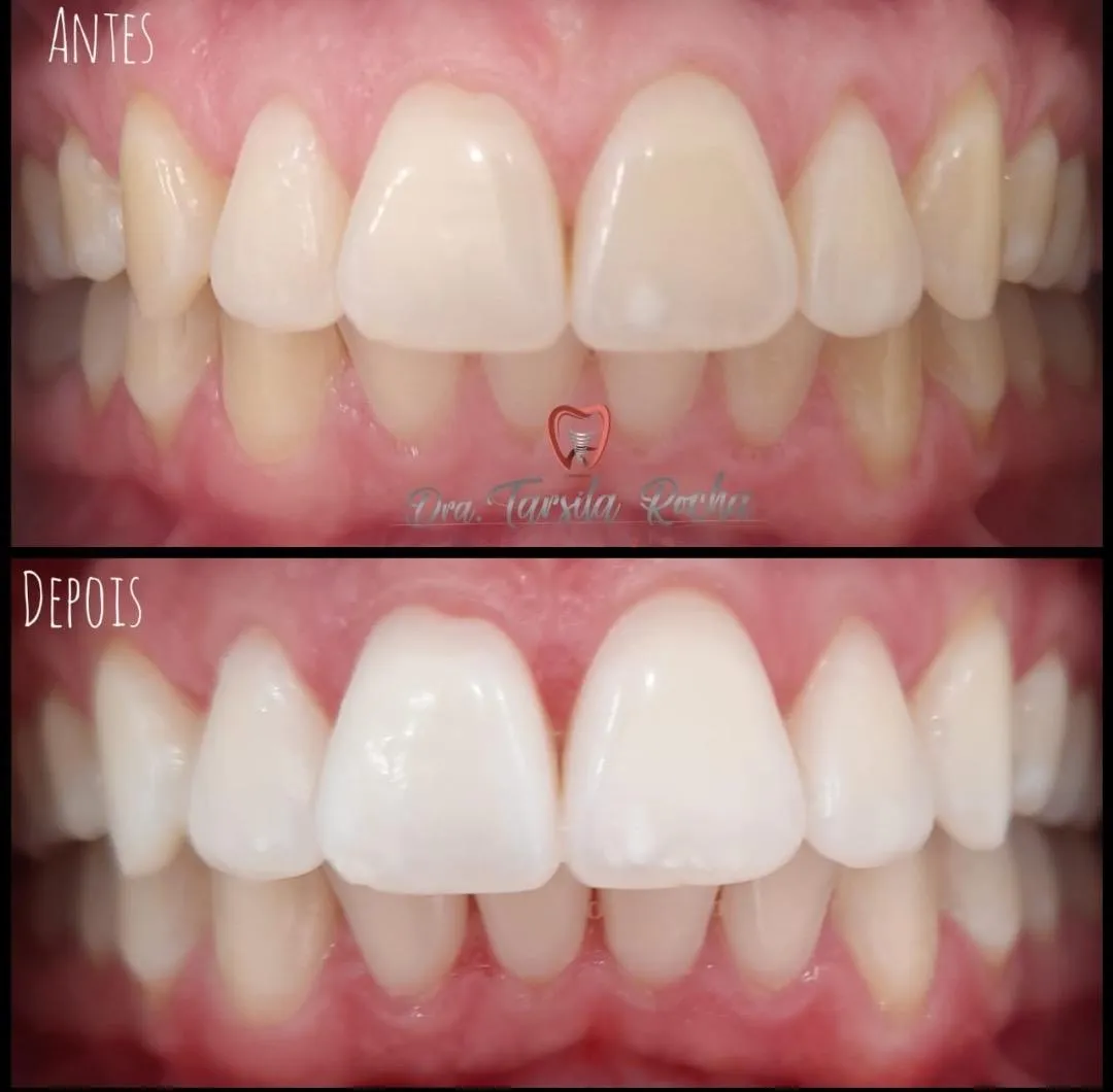 Clareamento Dental Caseiro - Dra. Tarsila Rocha